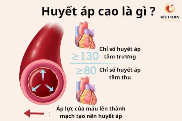 Huyết áp cao là gì